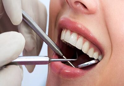 Teeth-Cleaning-and-Polishing-in-Riyadh