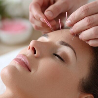 facial-acupuncture-treatment