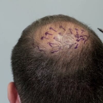 ما-هي-نسبة-نجاح-زراعة-الشعر-في-منطقة-التاج؟-2