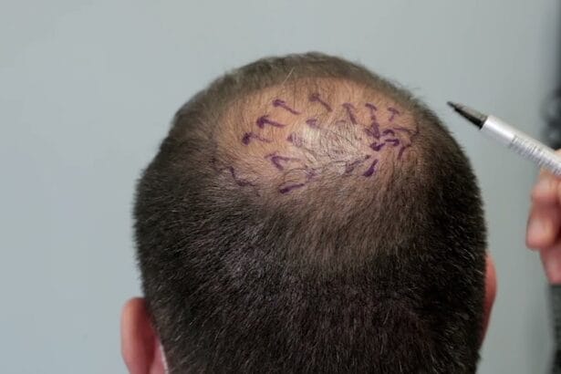 ما-هي-نسبة-نجاح-زراعة-الشعر-في-منطقة-التاج؟-2