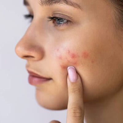 Can-Acne-Treatment-reduce-redness-and-inflammation