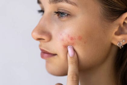 Can-Acne-Treatment-reduce-redness-and-inflammation