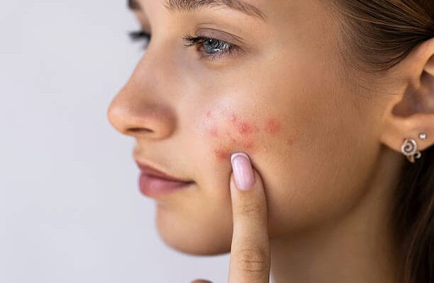 Can-Acne-Treatment-reduce-redness-and-inflammation