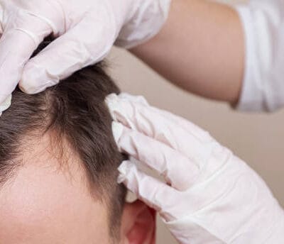 Can-Hair-Loss-Treatment-work-for-oily-scalp