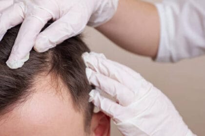 Can-Hair-Loss-Treatment-work-for-oily-scalp