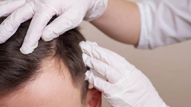 Can-Hair-Loss-Treatment-work-for-oily-scalp