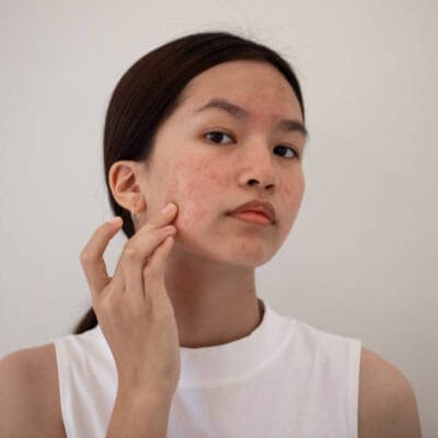 Can-Laser-Acne-Scar-Treatment-Reduce-Redness-Fast