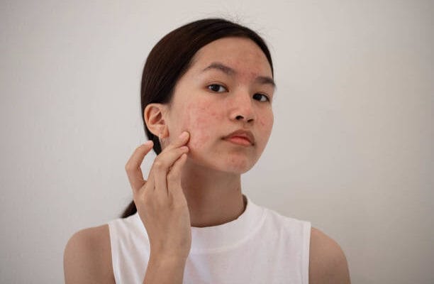 Can-Laser-Acne-Scar-Treatment-Reduce-Redness-Fast