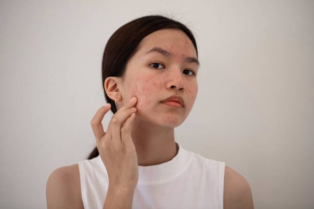 Can-Laser-Acne-Scar-Treatment-Reduce-Redness-Fast