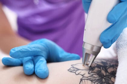 Can-Laser-Tattoo-Removal-Remove-Fresh-Tattoos
