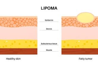 Can-Lipomas-Go-Away-Without-Medical-Intervention