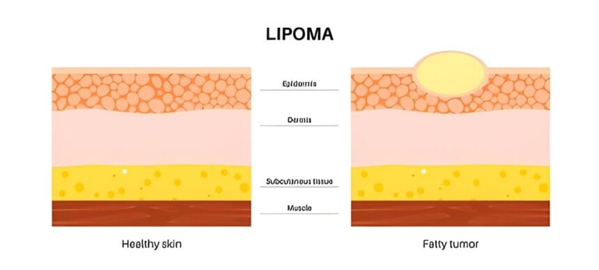 Can-Lipomas-Go-Away-Without-Medical-Intervention