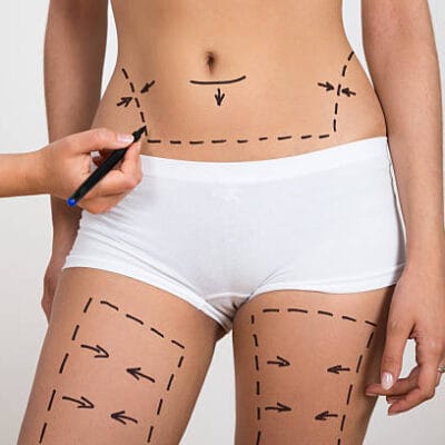 Can-Liposuction-Boost-Self-Esteem-Quickly