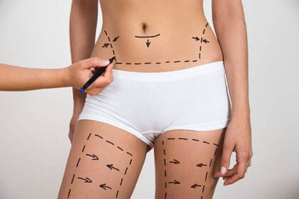 Can-Liposuction-Boost-Self-Esteem-Quickly