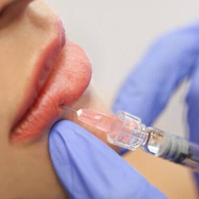 Can-Russian-lip-Fillers-correct-lip-asymmetry