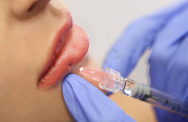 Can-Russian-lip-Fillers-correct-lip-asymmetry