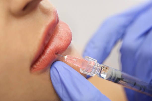 Can-Russian-lip-Fillers-correct-lip-asymmetry