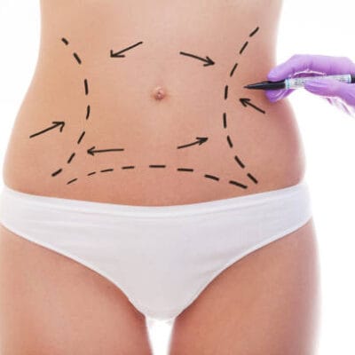 Can-Tummy-Tuck-Tighten-Sagging-Skin-Quickly