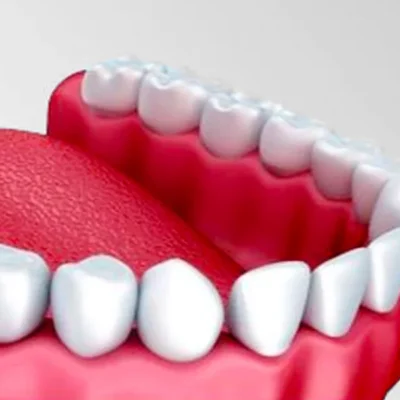 Dental-Implants-2.png