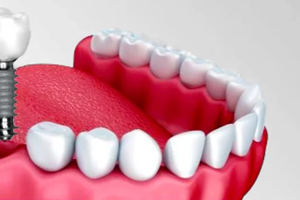 Dental-Implants-2.png