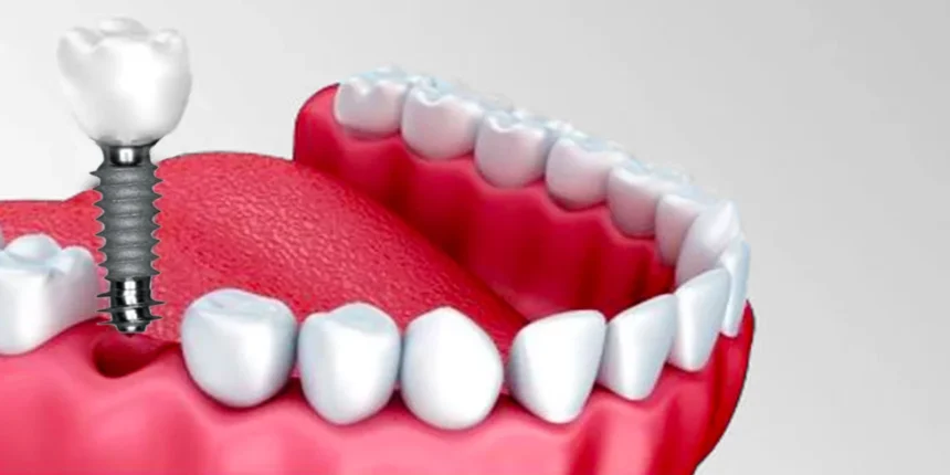 Dental-Implants-2.png