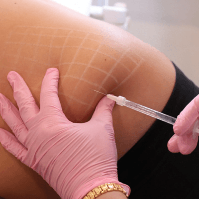 Do-Fat-Melting-Injections-Improve-Body-Shape