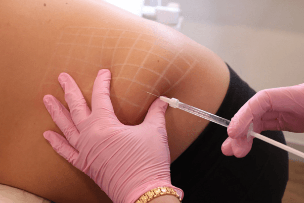 Do-Fat-Melting-Injections-Improve-Body-Shape