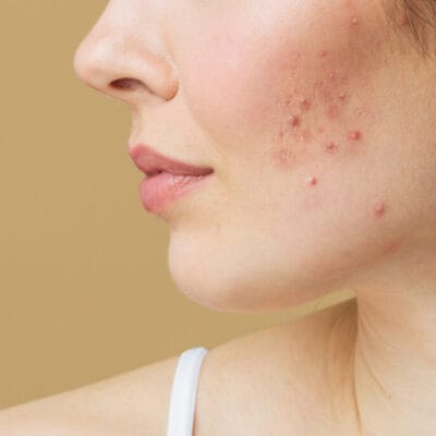 Does-Acne-Treatment-Remove-Scars-Quickly