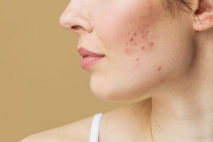 Does-Acne-Treatment-Remove-Scars-Quickly