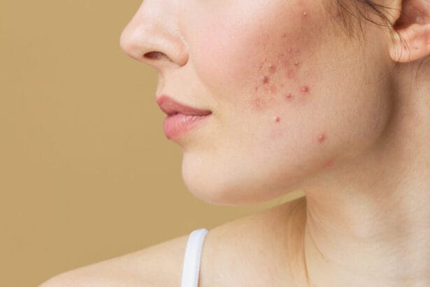 Does-Acne-Treatment-Remove-Scars-Quickly