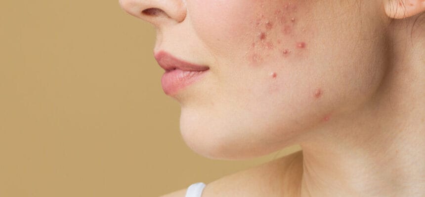 Does-Acne-Treatment-Remove-Scars-Quickly