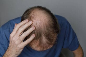 Does-GFC-Treatment-for-Hair-Need-Downtime-to-Heal