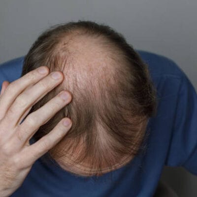 Does-GFC-Treatment-for-Hair-Need-Downtime-to-Heal