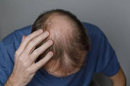 Does-GFC-Treatment-for-Hair-Need-Downtime-to-Heal