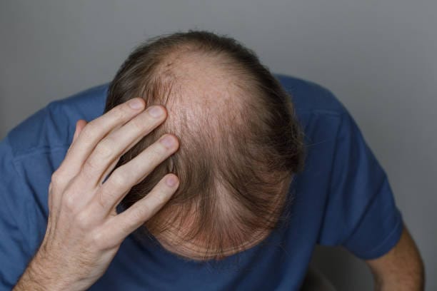 Does-GFC-Treatment-for-Hair-Need-Downtime-to-Heal