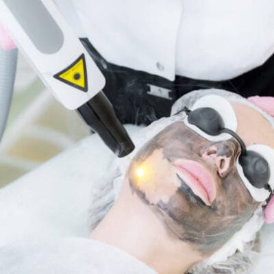 Does-Laser-Carbon-Peel-Help-Fade-Stubborn-Marks-and-Spots