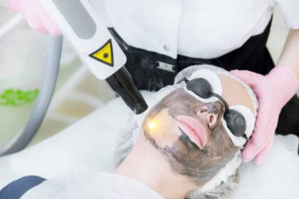 Does-Laser-Carbon-Peel-Help-Fade-Stubborn-Marks-and-Spots