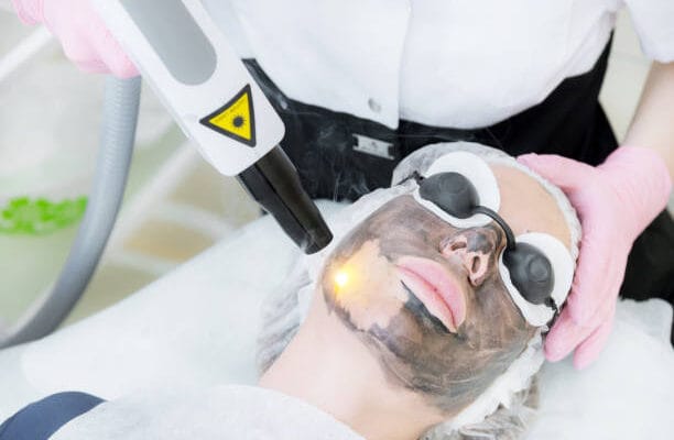 Does-Laser-Carbon-Peel-Help-Fade-Stubborn-Marks-and-Spots