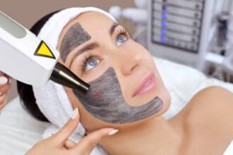 Does-Laser-Carbon-Peel-help-control-excess-oil