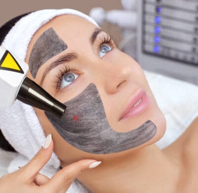 Does-Laser-Carbon-Peel-help-control-excess-oil