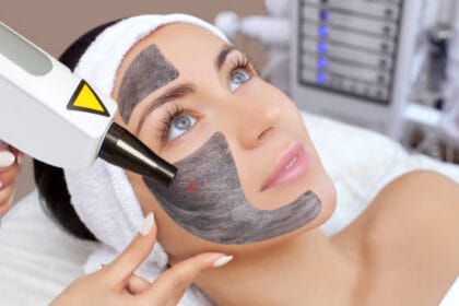 Does-Laser-Carbon-Peel-help-control-excess-oil