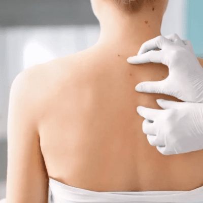 Does-Mole-Removal-Help-with-Cosmetic-Concerns