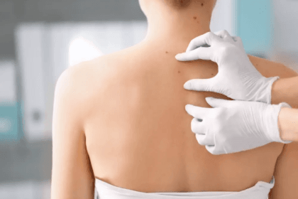 Does-Mole-Removal-Help-with-Cosmetic-Concerns