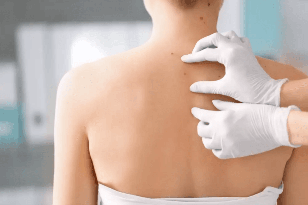 Does-Mole-Removal-Help-with-Cosmetic-Concerns