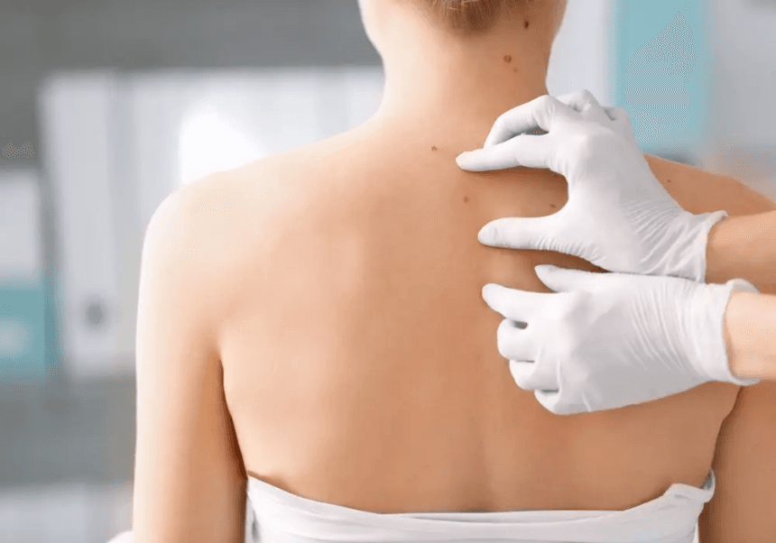 Does-Mole-Removal-Help-with-Cosmetic-Concerns