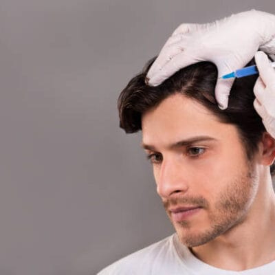 Does-Stem-Cell-Hair-Transplant-Work-on-Crown-Hair-Loss-Well