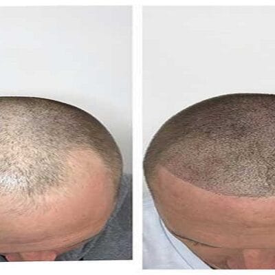 Hair-Thinning-Treatment-Vadodara