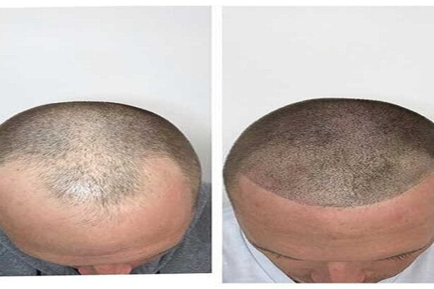 Hair-Thinning-Treatment-Vadodara