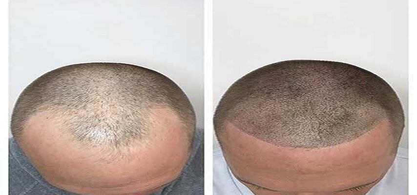 Hair-Thinning-Treatment-Vadodara