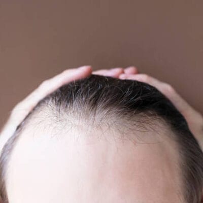 How-Can-Hair-Loss-Treatment-Improve-Hairline-Shape